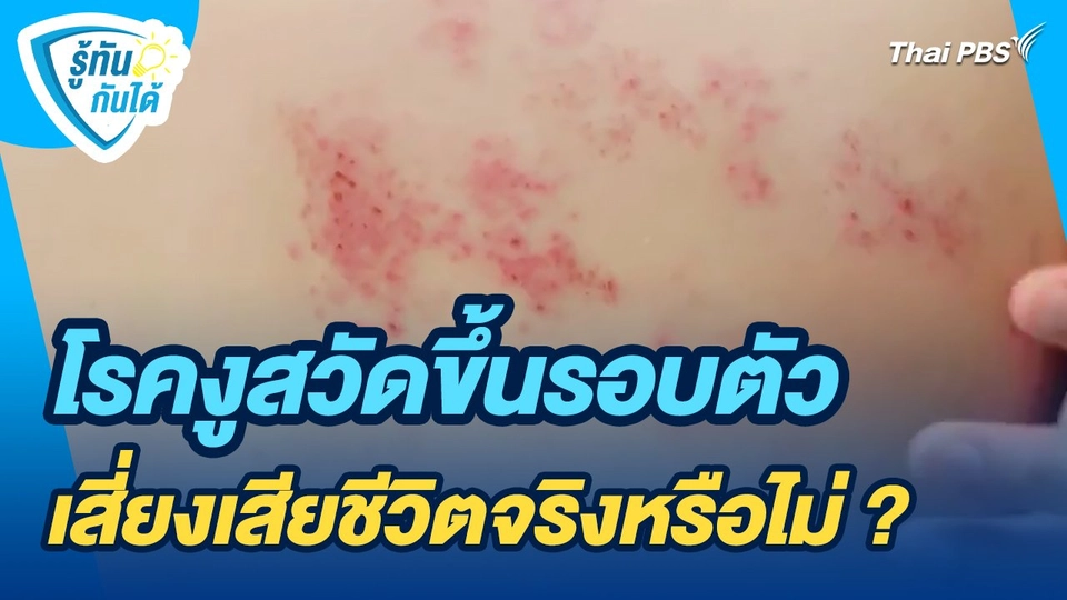 รู้ทันกันได้ : โรคงูสวัดขึ้นรอบตัวเสี่ยงเสียชีวิตจริงหรือไม่ ?