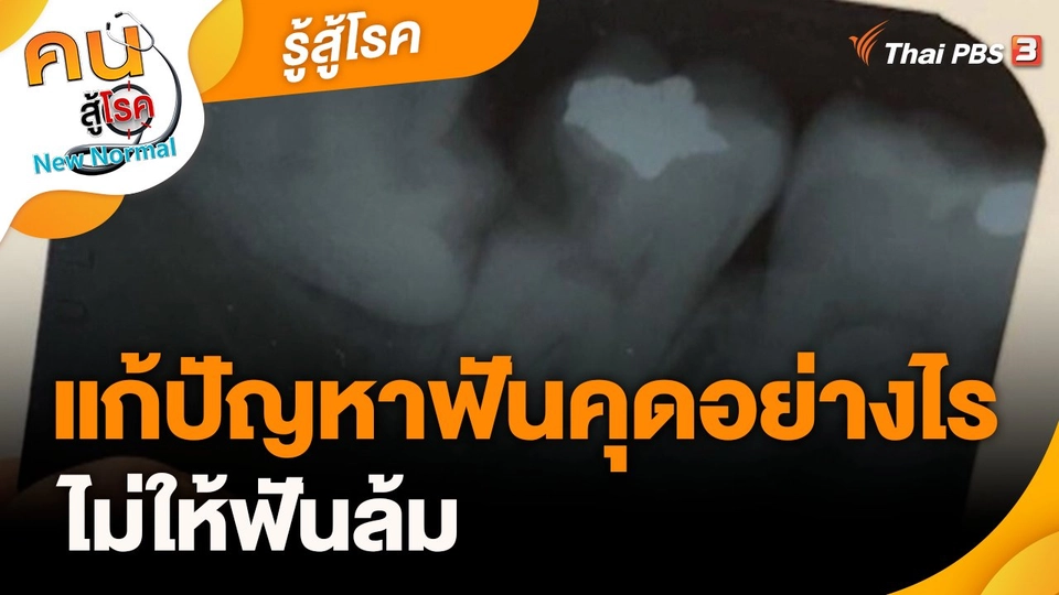 รู้สู้โรค : แก้ปัญหาฟันคุดอย่างไรไม่ให้ฟันล้ม
