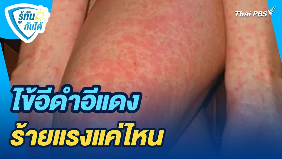 รู้ทันกันได้ : ไข้อีดำอีแดง ร้ายแรงแค่ไหน