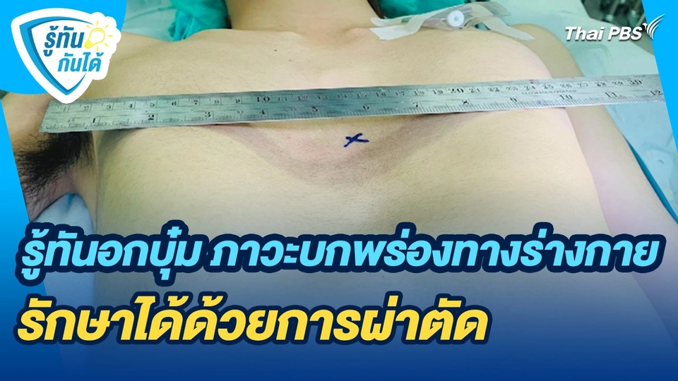 รู้ทันกันได้ : รู้ทันอกบุ๋ม ภาวะบกพร่องทางร่างกาย รักษาได้ด้วยการผ่าตัด