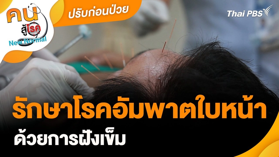 ปรับก่อนป่วย : รักษาโรคอัมพาตใบหน้าด้วยการฝังเข็ม