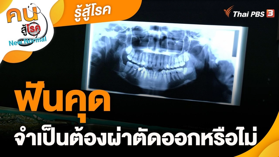 ​รู้สู้โรค : ฟันคุดจำเป็นต้องผ่าตัดออกหรือไม่