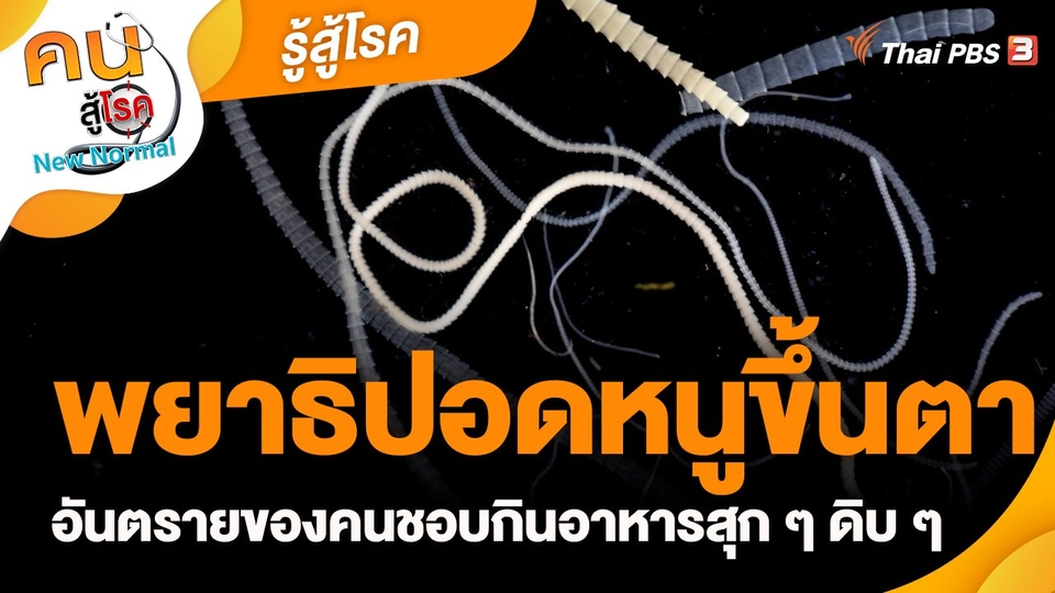 ​รู้สู้โรค : พยาธิปอดหนูขึ้นตา อันตรายของคนชอบกินอาหารสุก ๆ ดิบ ๆ