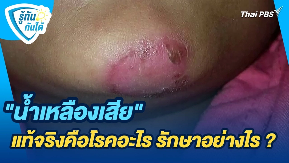 รู้ทันกันได้ : "น้ำเหลืองเสีย" แท้จริงคือโรคอะไร รักษาอย่างไร ?