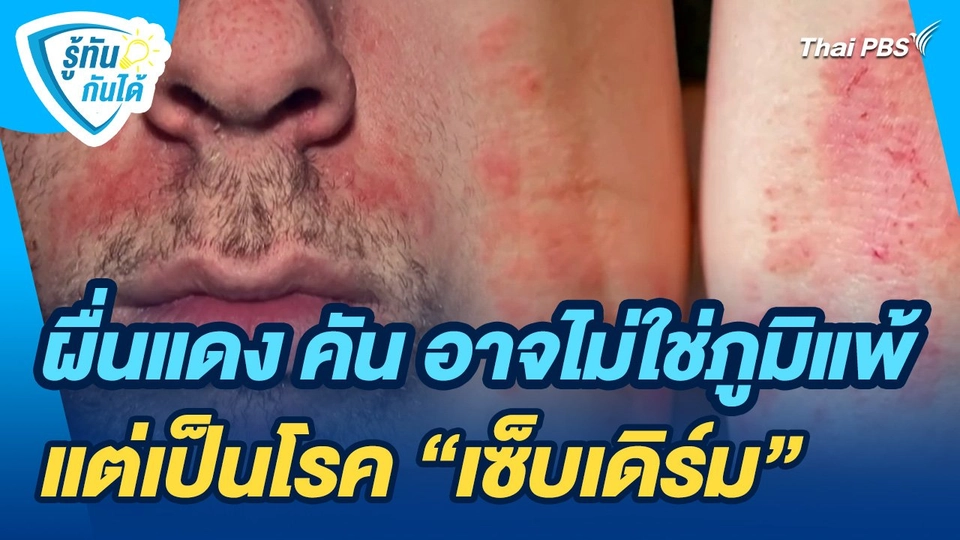 รู้ทันกันได้ : ผื่นแดง คัน อาจไม่ใช่ภูมิแพ้ แต่เป็นโรค "เซ็บเดิร์ม"