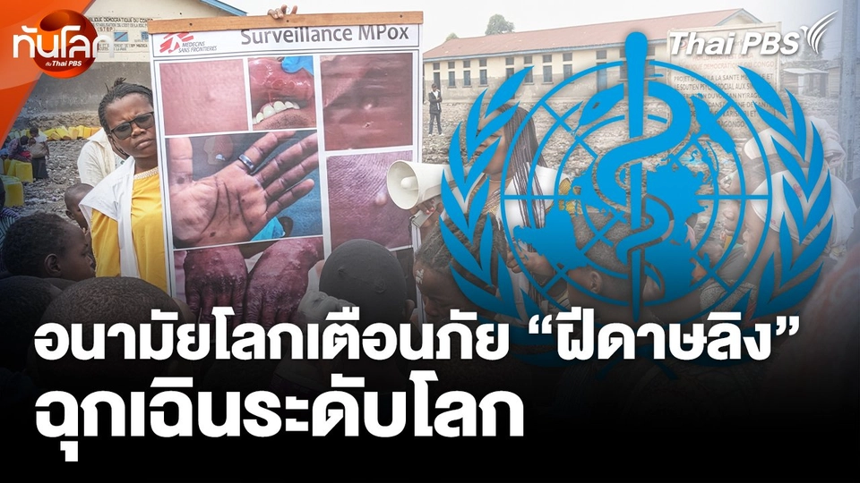 อนามัยโลกเตือนภัย "ฝีดาษลิง" ฉุกเฉินระดับโลก