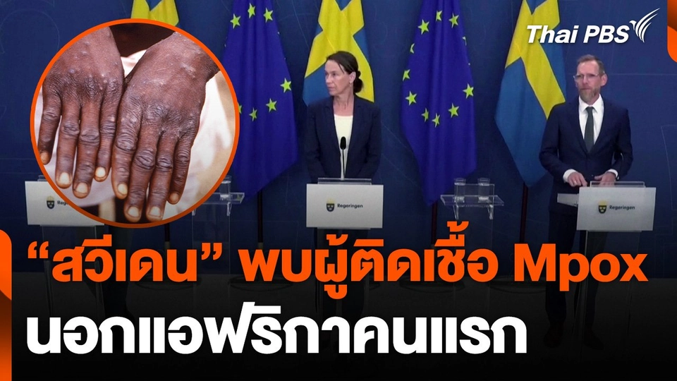 "สวีเดน" พบผู้ติดเชื้อ Mpox หรือ ฝีดาษลิง นอกแอฟริกาคนแรก
