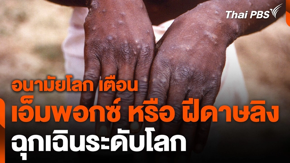 อนามัยโลก เตือน "เอ็มพอกซ์" หรือ "ฝีดาษลิง" ฉุกเฉินระดับโลก
