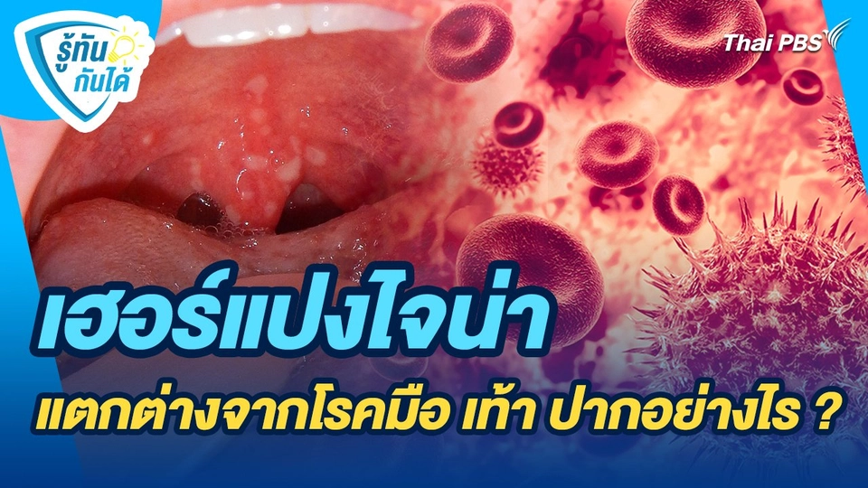 รู้ทันกันได้ : เฮอร์แปงไจน่าแตกต่างจากโรคมือ เท้า ปากอย่างไร ?