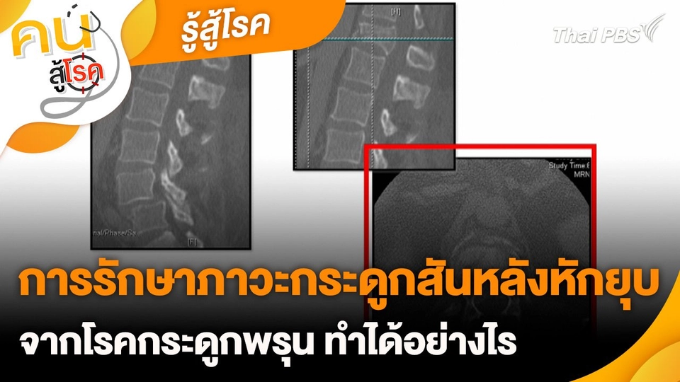 รู้สู้โรค : การรักษาภาวะกระดูกสันหลังหักยุบจากโรคกระดูกพรุน ทำได้อย่างไร