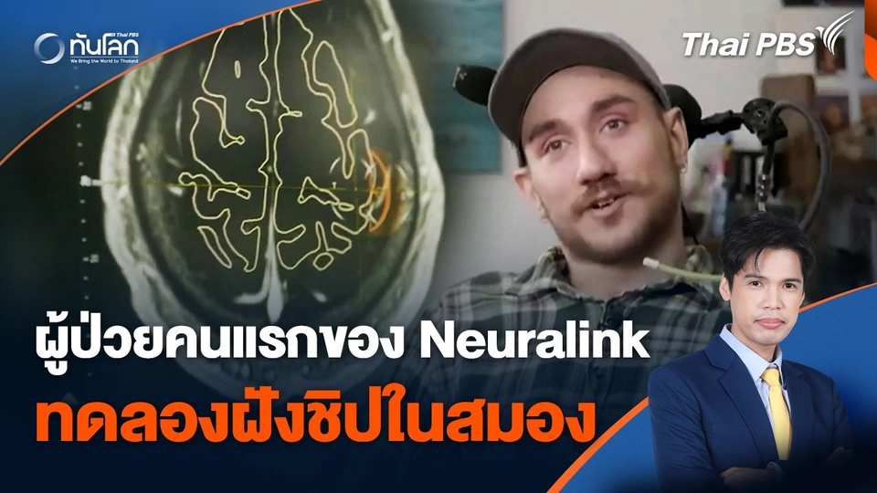 Neuralink เปิดเผยผู้ป่วยคนแรกทดลองฝังชิปในสมอง