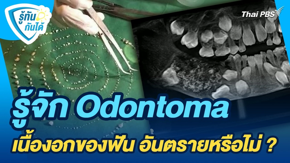 รู้ทันกันได้ : รู้จัก Odontoma เนื้องอกของฟัน อันตรายหรือไม่ ?