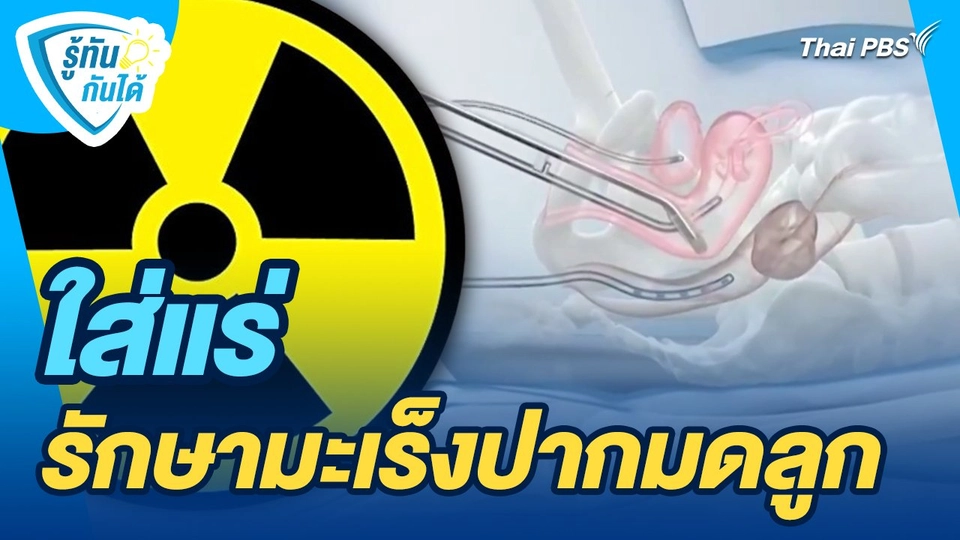 รู้ทันกันได้ : ใส่แร่ รักษามะเร็งปากมดลูก