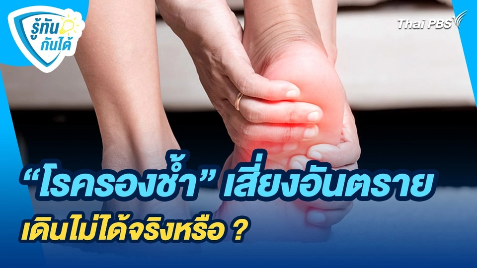 รู้ทันกันได้ : "โรครองช้ำ" ปล่อยไว้เสี่ยงอันตรายเดินไม่ได้จริงหรือ ?