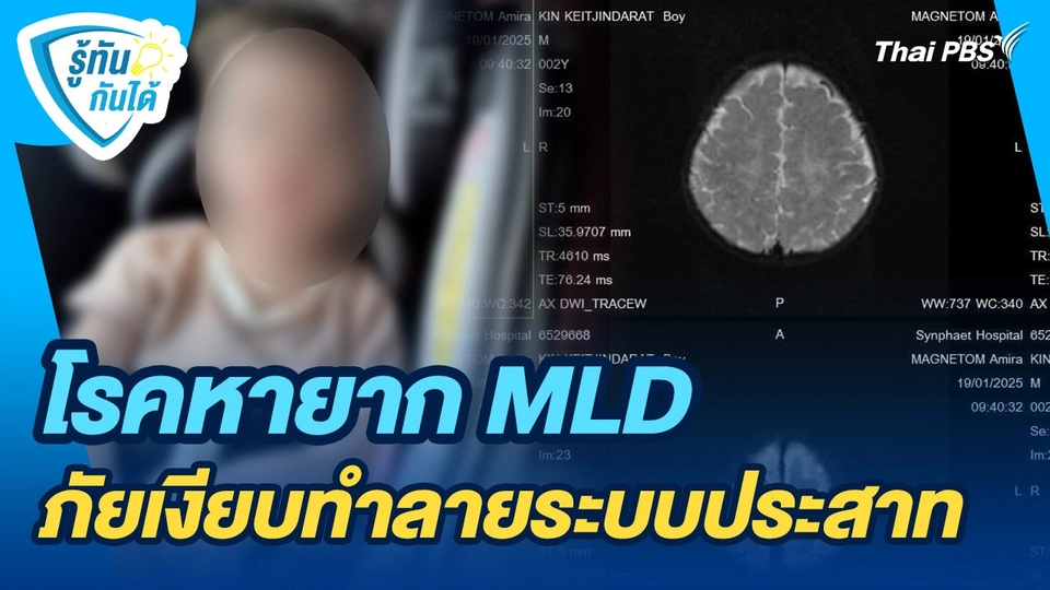 รู้ทันกันได้ : โรคหายาก MLD ภัยเงียบทำลายระบบประสาท