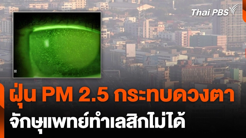 ฝุ่น PM 2.5 กระทบดวงตา จักษุแพทย์ทำเลสิกไม่ได้