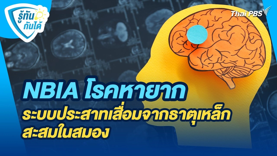 รู้ทันกันได้ : NBIA โรคหายาก ระบบประสาทเสื่อมจากธาตุเหล็กสะสมในสมอง