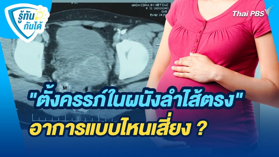รู้ทันกันได้ : "ตั้งครรภ์ในผนังลำไส้ตรง" อาการแบบไหนเสี่ยง ?
