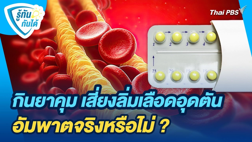 รู้ทันกันได้ : กินยาคุม เสี่ยงลิ่มเลือดอุดตัน - อัมพาตจริงหรือไม่ ?