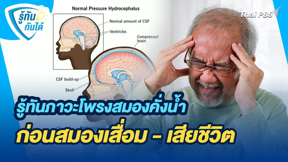รู้ทันกันได้ : รู้ทันภาวะโพรงสมองคั่งน้ำ ก่อนสมองเสื่อม - เสียชีวิต