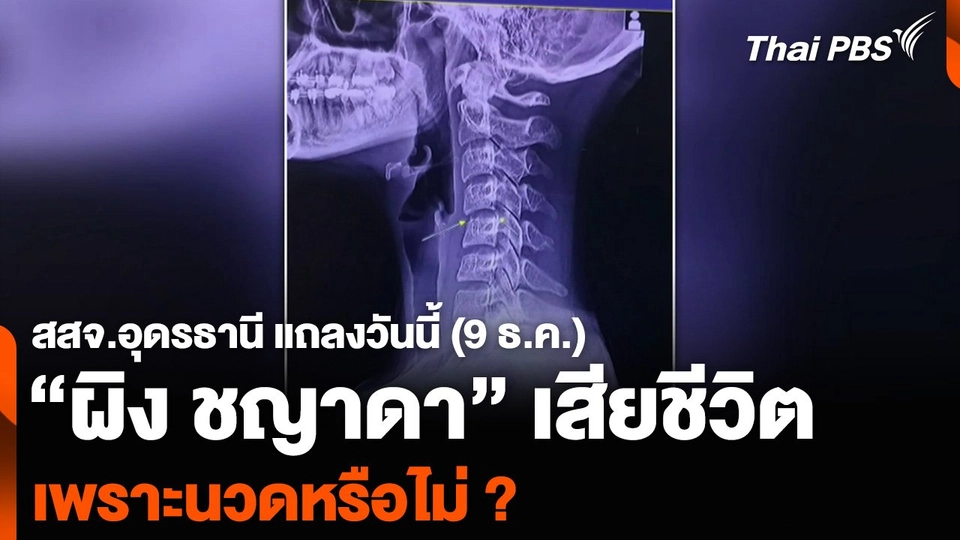 สสจ.อุดรธานี แถลงวันนี้ (9 ธ.ค.) “ผิง ชญาดา” เสียชีวิตเพราะนวดหรือไม่ ?