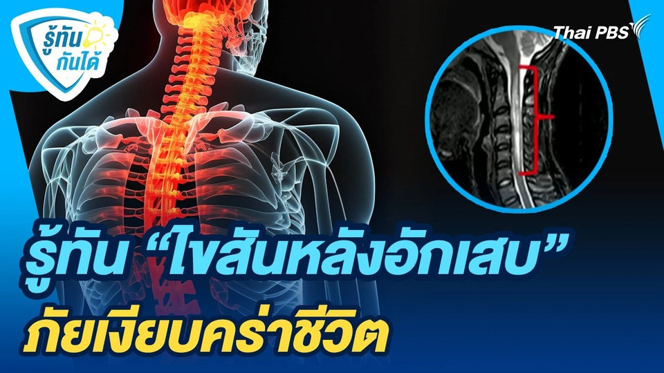 รู้ทันกันได้ : รู้ทัน "ไขสันหลังอักเสบ" ภัยเงียบคร่าชีวิต
