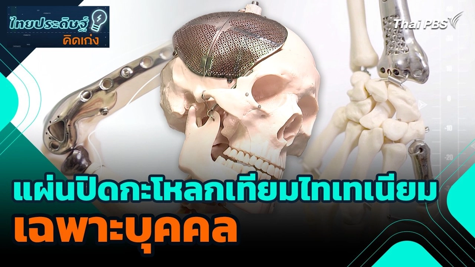 ไทยประดิษฐ์คิดเก่ง : แผ่นปิดกะโหลกเทียมไทเทเนียมเฉพาะบุคคล