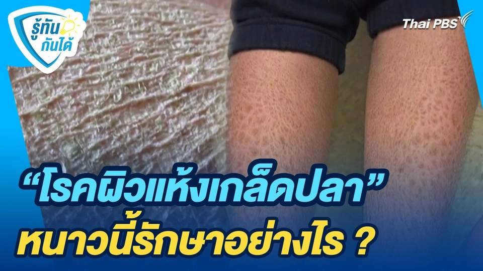 รู้ทันกันได้ : "โรคผิวแห้งเกล็ดปลา" หนาวนี้รักษาอย่างไร ?