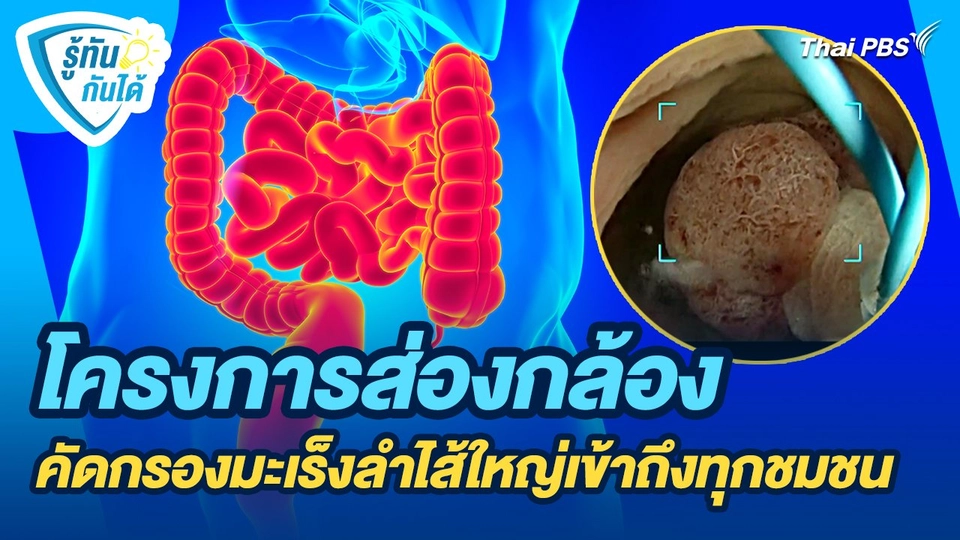 รู้ทันกันได้ : โครงการส่องกล้องคัดกรองมะเร็งลำไส้ใหญ่เข้าถึงทุกชมชน