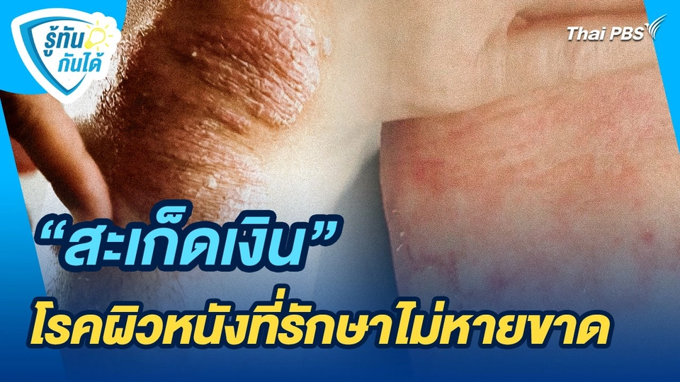 รู้ทันกันได้ : "สะเก็ดเงิน" โรคผิวหนังที่รักษาไม่หายขาด