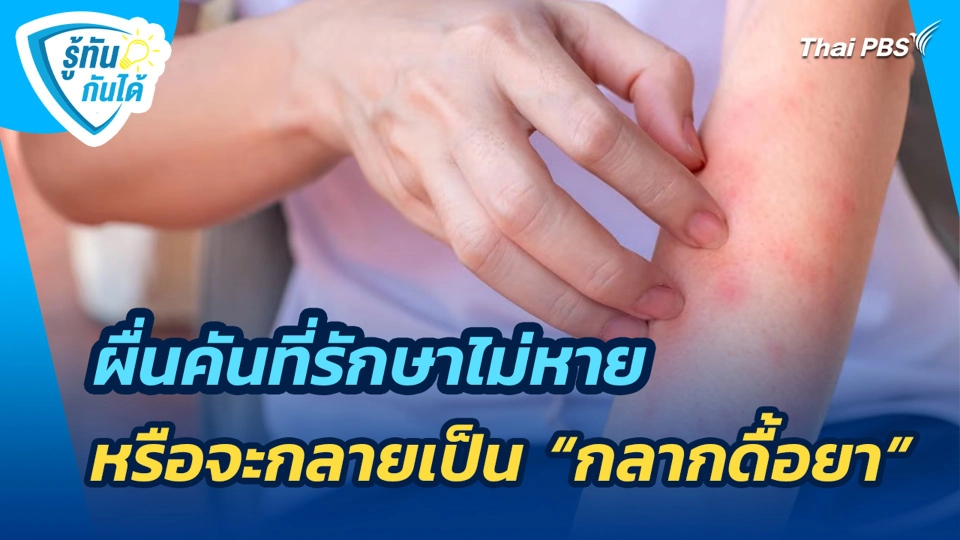 ผื่นคันที่รักษาไม่หาย หรือจะกลายเป็น "กลากดื้อยา"