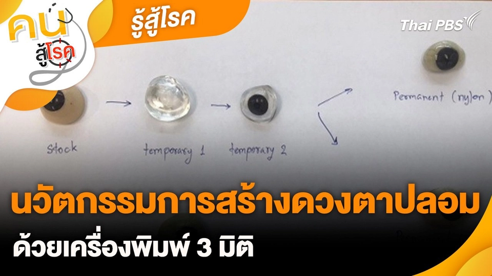 รู้สู้โรค : นวัตกรรมการสร้างดวงตาปลอมด้วยเครื่องพิมพ์ 3 มิติ