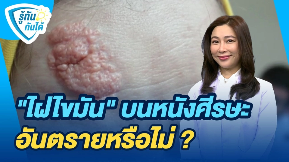 รู้ทันกันได้ : "ไฝไขมัน" บนหนังศีรษะ อันตรายหรือไม่ ?