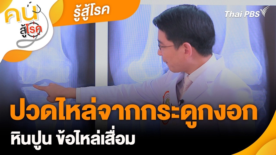 รู้สู้โรค : ปวดไหล่จากกระดูกงอก หินปูน ข้อไหล่เสื่อม