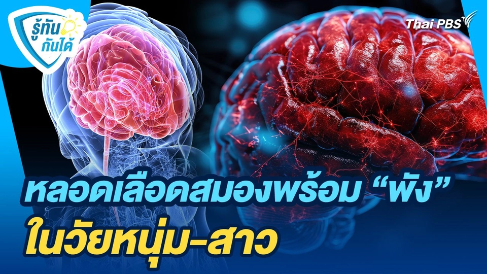 รู้ทันกันได้ : Stroke in the young หลอดเลือดสมองพร้อม "พัง" ในวัยหนุ่ม-สาว