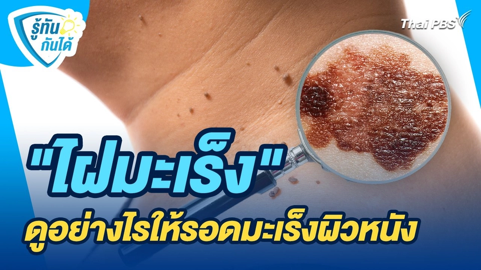 รู้ทันกันได้ : "ไฝมะเร็ง"...ดูอย่างไรให้รอดมะเร็งผิวหนัง