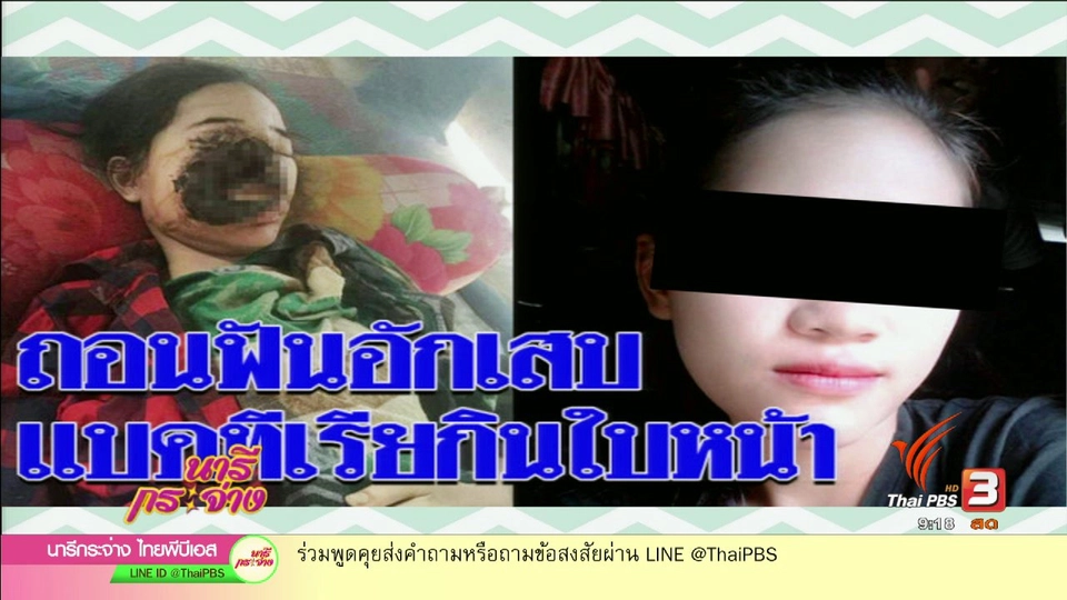 จริงหรือ!! แบคทีเรียกินเนื้อคนเพราะไปทำฟัน ?