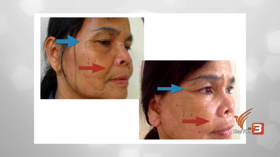 รู้สู้โรค : ศัลยกรรมแก้หนังตาตก