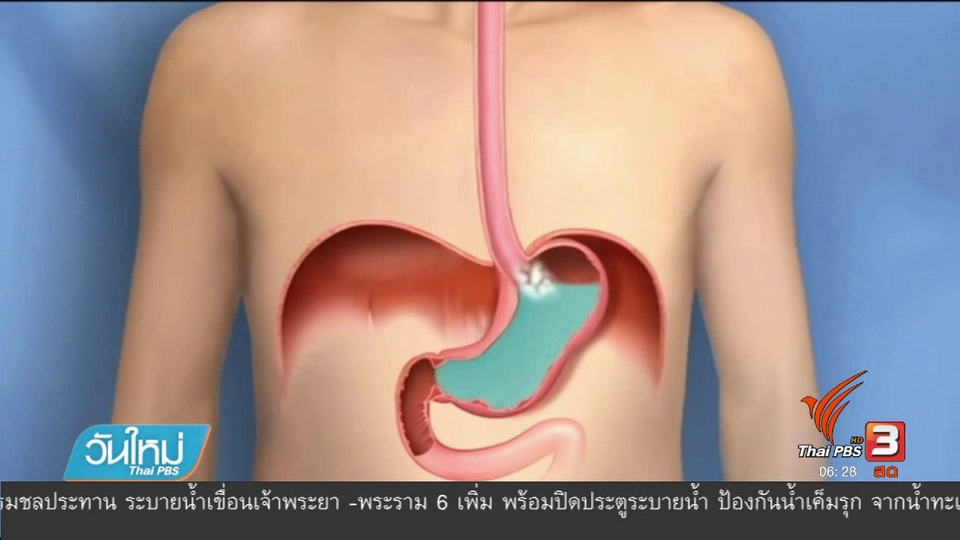 108 สุขภาพ : ปรับพฤติกรรม ป้องกันโรคกรดไหลย้อน