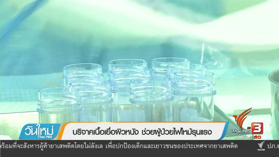 108 สุขภาพ : บริจาคเนื้อเยื่อผิวหนัง ช่วยผู้ป่วยไฟไหม้รุนแรง