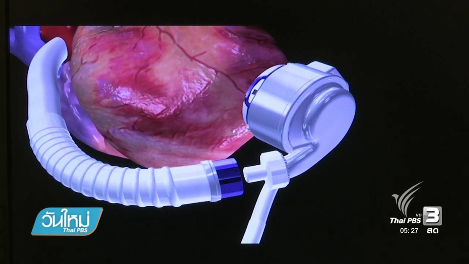 แพทย์รามาฯ ผ่าตัดหัวใจเทียมสำเร็จในไทย