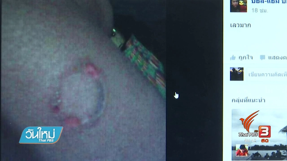 เด็ก ป.3 ถูกครูเผาขวดพลาสติกจี้ผิวบาดเจ็บ