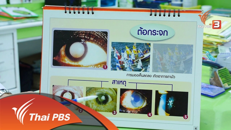 ผ่าตัดต้อกระจกสุก