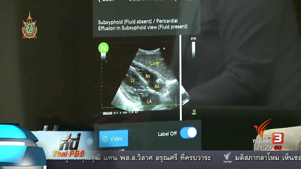 ที่นี่ Thai PBS : แอพลิเคชันช่วยวิเคราะห์ผู้ป่วยวิกฤต
