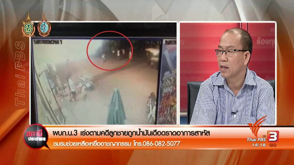 ​ผบก.น.3 เร่งตามคดีลูกชายถูกน้ำมันเดือดราดอาการสาหัส