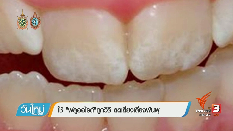 108 สุขภาพ : ใช้ "ฟลูออไรด์"ถูกวิธี ลดเสี่ยงเลี่ยงฟันผุ