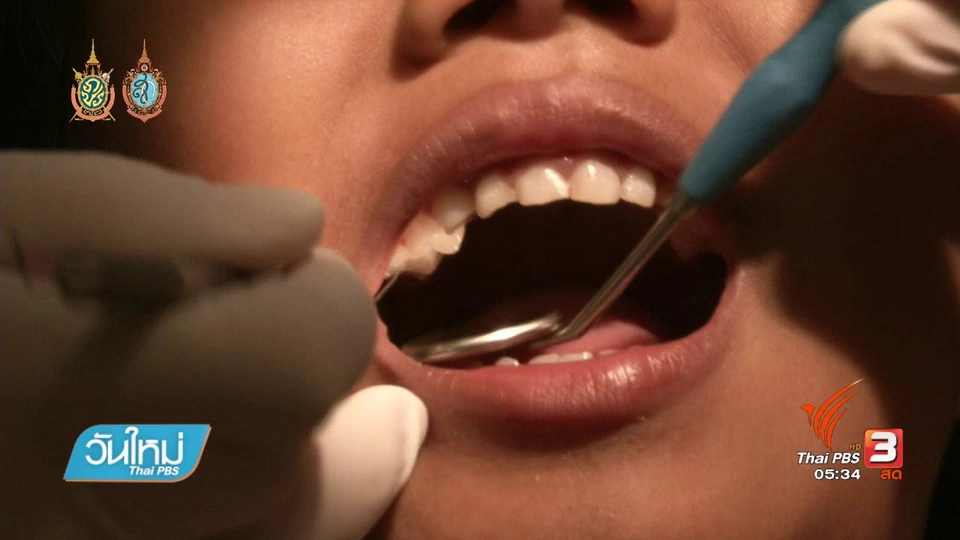 108 สุขภาพ :  ฟันน้ำนมผุ ส่งผลให้พัฒนาการเด็กล่าช้า