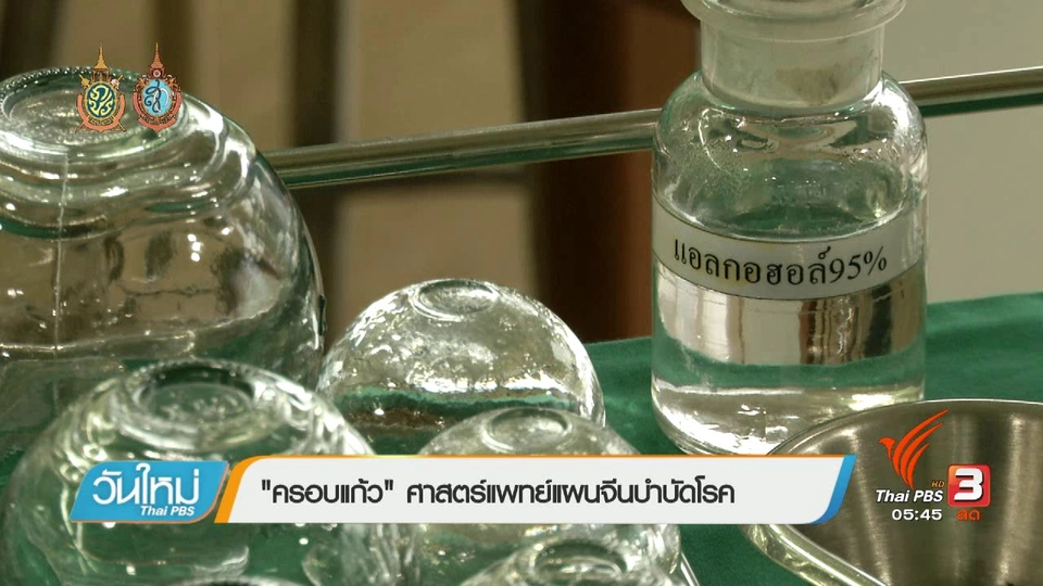 108 สุขภาพ : "ครอบแก้ว" ศาสตร์แพทย์แผนจีนบำบัดโรค