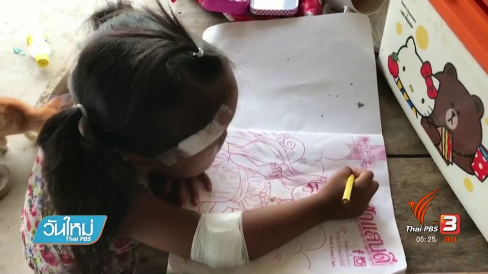 สุนัขกัดเด็กหญิง 4 ปี บาดเจ็บ