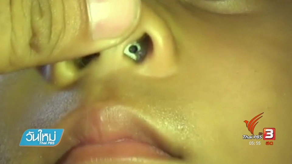 กู้ภัยช่วยเด็ก 4 ขวบ หลังยัดลูกเต๋าเข้ารูจมูก